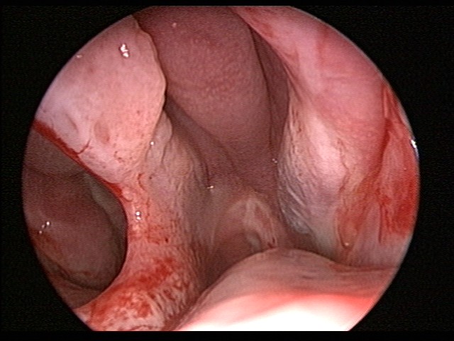 septal perforation