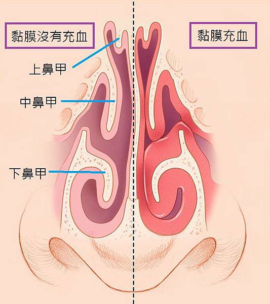 黏膜充血