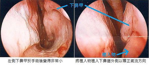 empty nose implant