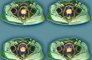 prostatecancerscreening.jpg