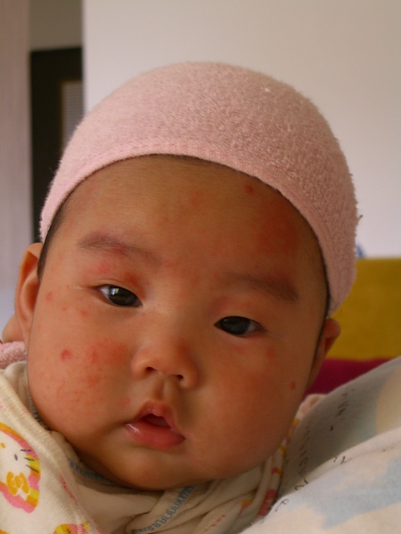 濕疹,蚊子叮,過敏體質的謝嬉嬉