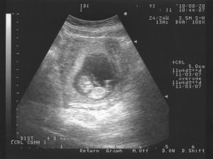 baby photo Aug20 富baby的超音波照