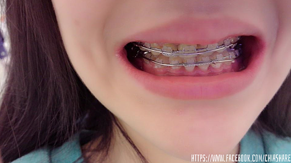 [ 牙套日记 ] no.17 牙齿矫正增加铁线&上下互拉橡皮筋