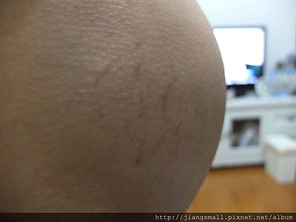 32W妊娠紋-右 32W妊娠紋-右