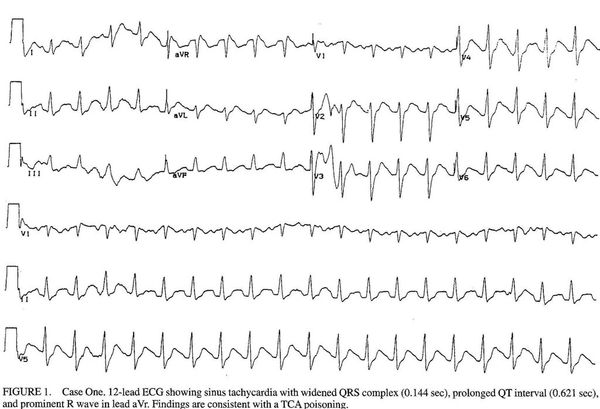 Ecg Tca