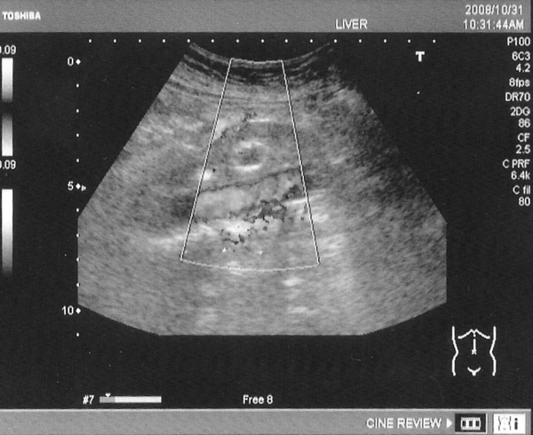 Ultrasound Horseshoe Kidney. Horseshoe kidney with