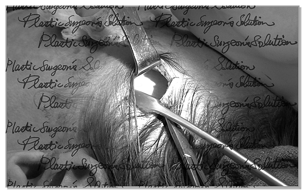 黑白處理_顳肌筋膜