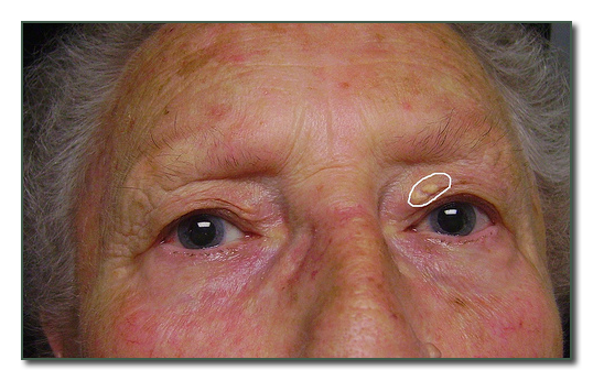 誰說眼皮割壞不能重修04 誰說眼皮割壞不能重修04