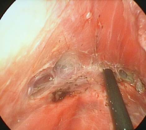 內視鏡隆乳2 內視鏡隆乳2