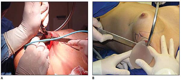 內視鏡隆乳3 內視鏡隆乳3