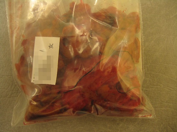 20091230甲狀腺結節腫切除05 20091230甲狀腺結節腫切除05