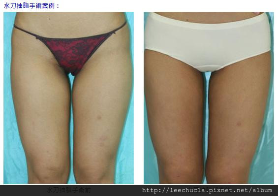 水刀抽脂案例e02-1.jpg