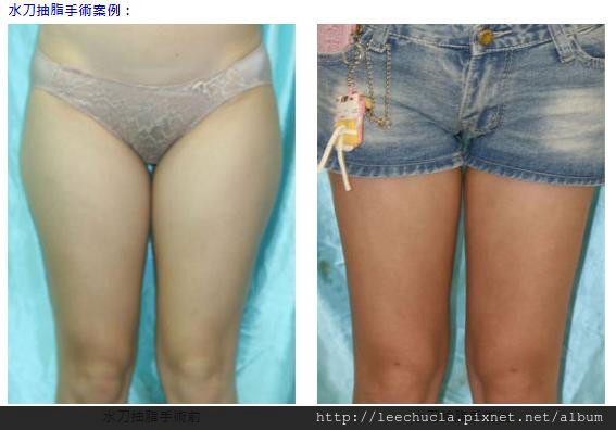 水刀抽脂案例e03-1.jpg 水刀抽脂案例e03-1.jpg