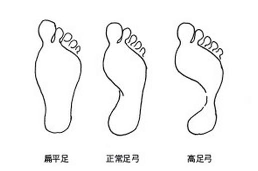 扁平足.jpg 扁平足.jpg