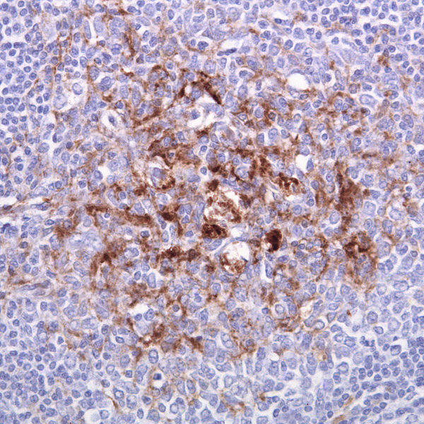 600px-VCJD_Tonsil.jpg 600px-VCJD_Tonsil.jpg