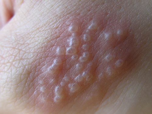 疾病的情绪-带状性疱疹@+药觉觉:+痞客邦