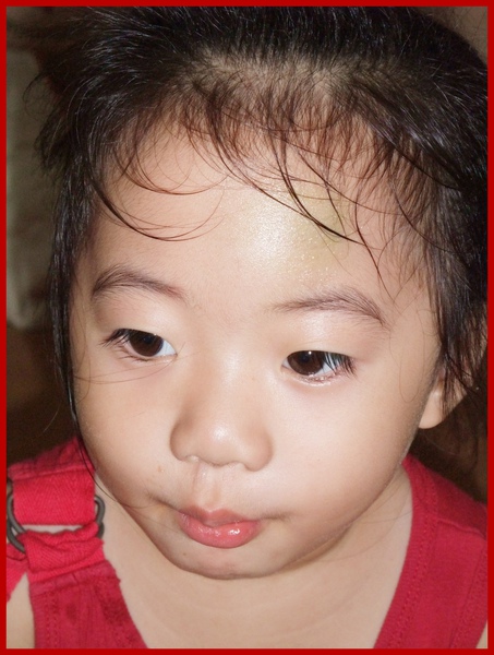2009.10.15妮妮撞傷了2..jpg 2009.10.15妮妮撞傷了2..jpg