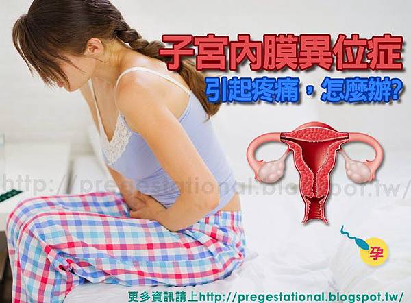 子宮內膜異位症 子宮內膜異位症