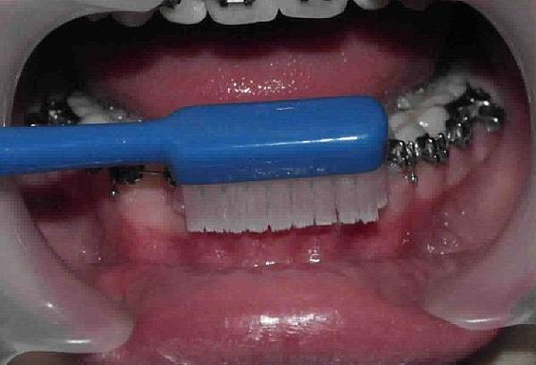 @矯正牙齒的刷牙方式(video)