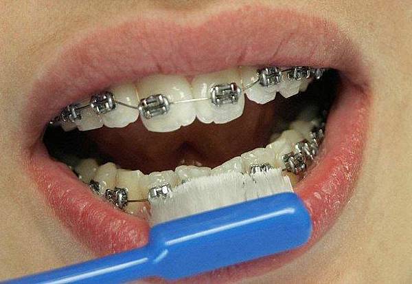 @矯正牙齒的刷牙方式(video)