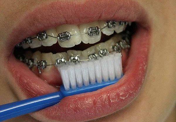 @矯正牙齒的刷牙方式(video)