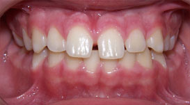 anterior-spacing1-before