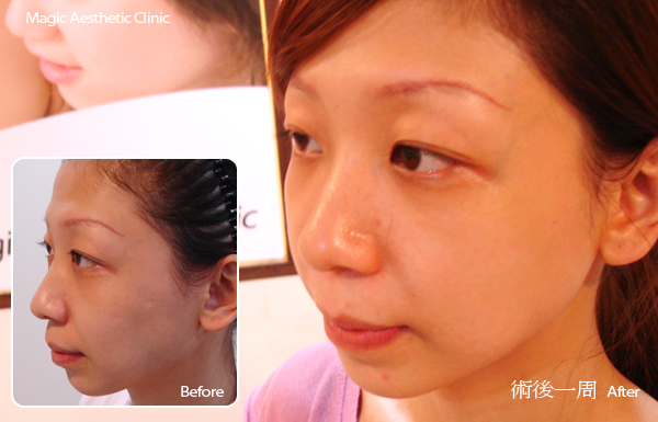 白瓷娃娃淨膚雷射