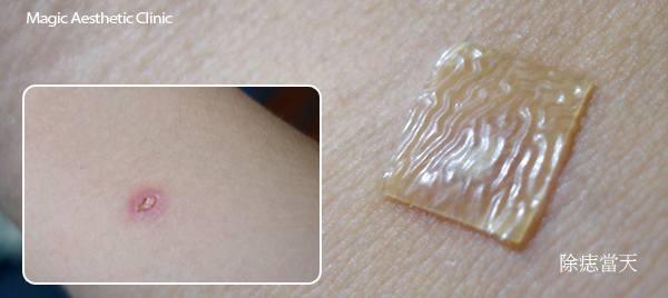 雷射除痣