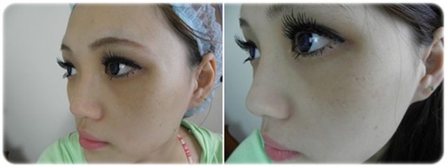 白瓷娃娃淨膚雷射