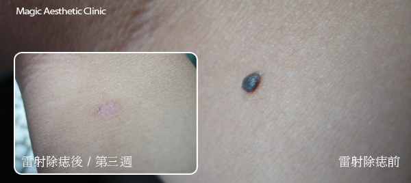 雷射除痣