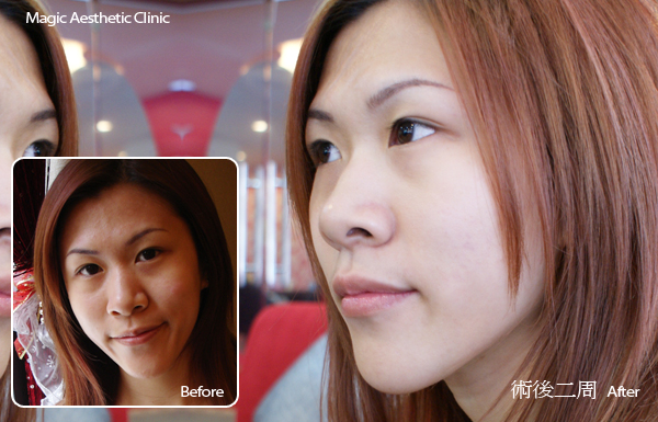 白瓷娃娃淨膚雷射