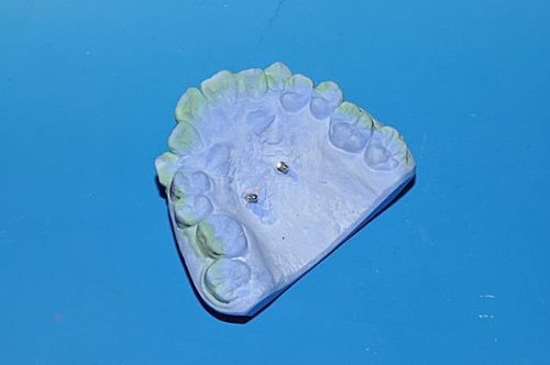 surgically assisted rapid palatal expansion pdf