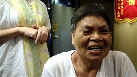 老人失智針灸恢復