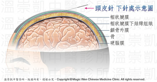 頭皮針特色與釋疑 溫崇凱神經系統針灸學 耳針眼針頭皮針權威 溫崇凱中醫診所 針灸逆轉潤潤罕病 醫學重大突破記者會 痞客邦