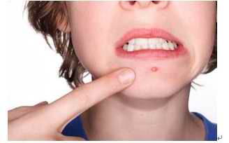 無患子 痘痘 粉刺 去角質6