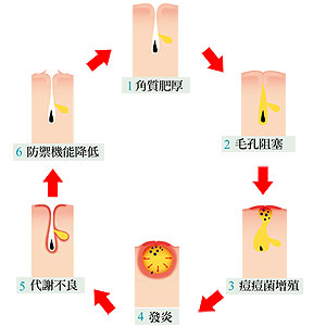 無患子 痘痘 粉刺 去角質11