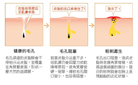 無患子 痘痘 粉刺 去角質14