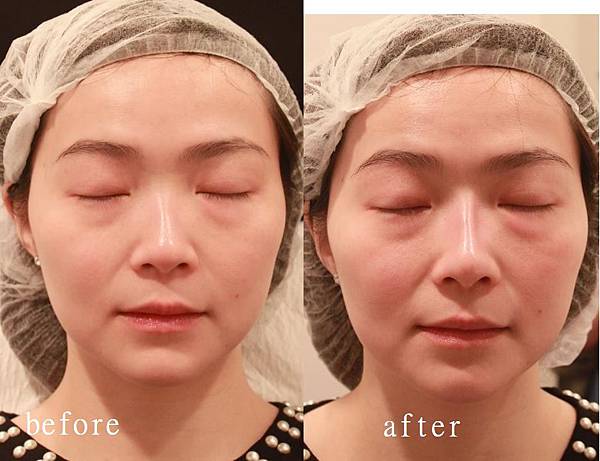 restylane2 restylane2