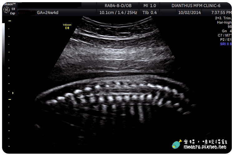 米特，味玩待敘｜部落格 © MEAT76｜台灣美食旅遊部落客｜2014-10-02-4【懷孕產檢紀錄7番外篇】24W+4D｜禾馨婦產科｜高層次超音波檢查 ( 自費3,800元 ) 建議20~24週檢查011.png