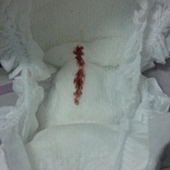 圖片辨識專區-石艾嘉--女寶寶出生五天，尿布上有血(假性月經)