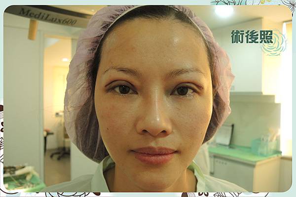術後網頁用.jpg 台中雙眼皮、台中雙眼皮手術推薦、混血精靈系、台中混血瞳、台中眼部整形、台中縫雙眼皮、台中割雙眼皮、台中韓式雙眼皮、台中日式訂書針雙眼皮、台中八字縫雙眼皮、台中開眼頭、開眼尾、台中提眼瞼肌手術、台中大小眼調整、台中雙眼皮手術價格、台中縫雙眼皮費用、台中雙眼皮手術醫生醫師推薦、台中雙眼皮權威名醫、台中整形外科醫學美容、台中菲仕美診所、台灣眼部整形專家,林孟羲院長|楊學穎醫師|許永昌醫師|朱純慧醫師