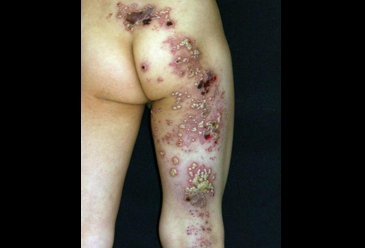 zovirax vs valtrex for shingles zovirax vs valtrex for shingles
