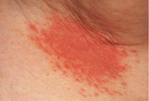 MedscapeCommon Dermatologic Diagnoses: 15 Rashes You ...