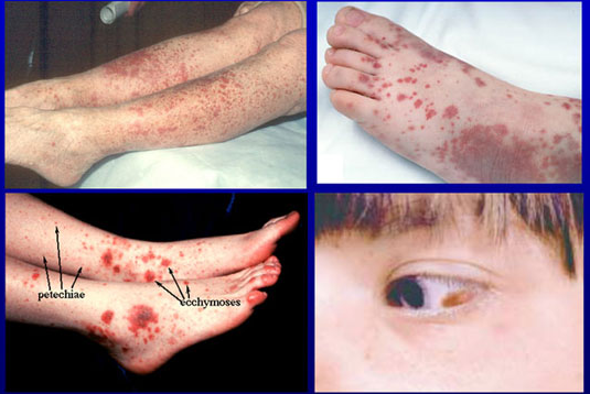 What is idiopathic thrombocytopenic purpura?