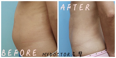 黃金超音波體雕 黃金超音波體雕