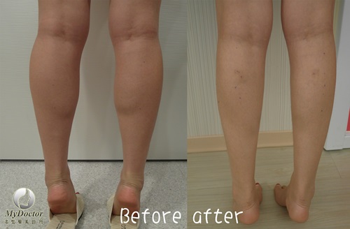 電波瘦小腿肌肉15 電波瘦小腿肌肉15
