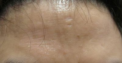 鼻妹急速飛針09 鼻妹急速飛針09