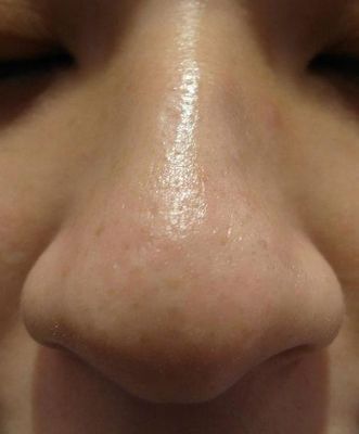 鼻妹急速飛針08 鼻妹急速飛針08