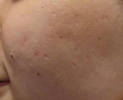 鼻妹急速飛針07 鼻妹急速飛針07