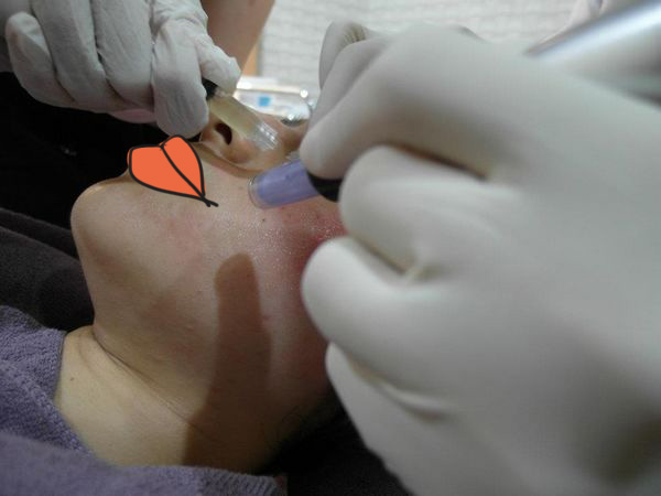 鼻妹急速飛針15 鼻妹急速飛針15